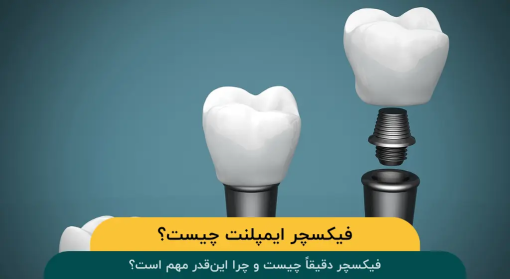 فیکسچر-ایمپلنت